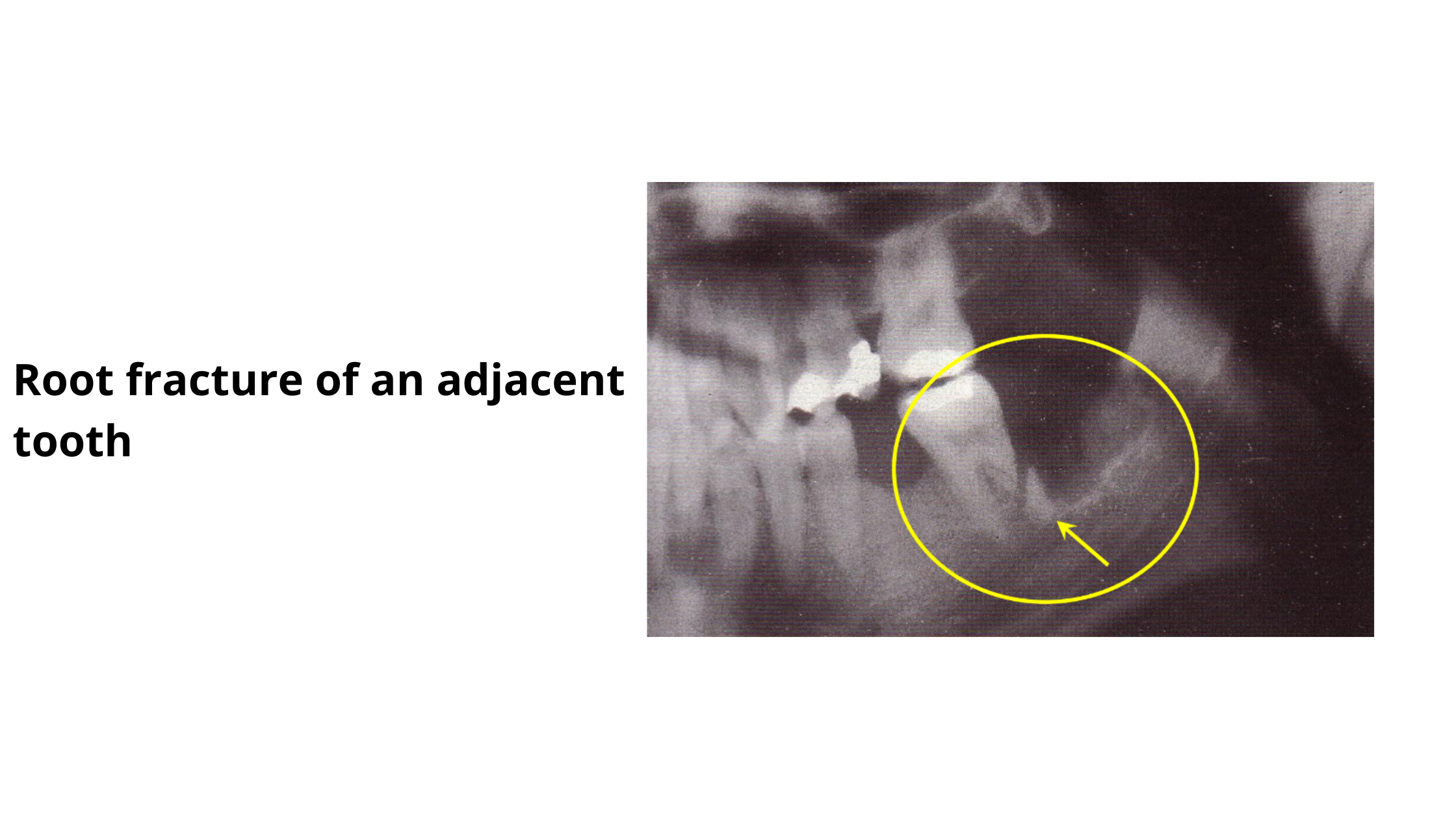 Dental X-ray showing fractured root of the tooth close to the extracted tooth
