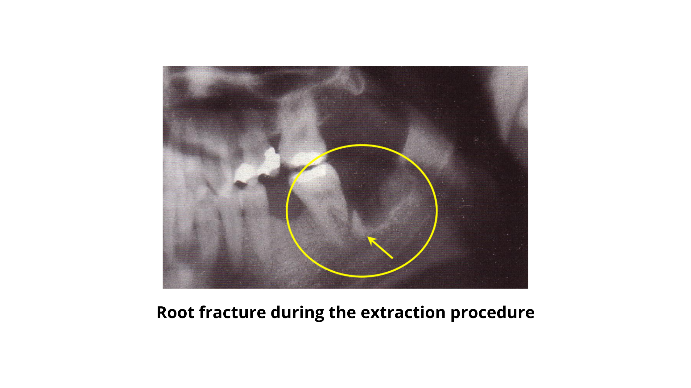 root fracture during the extraction procedure