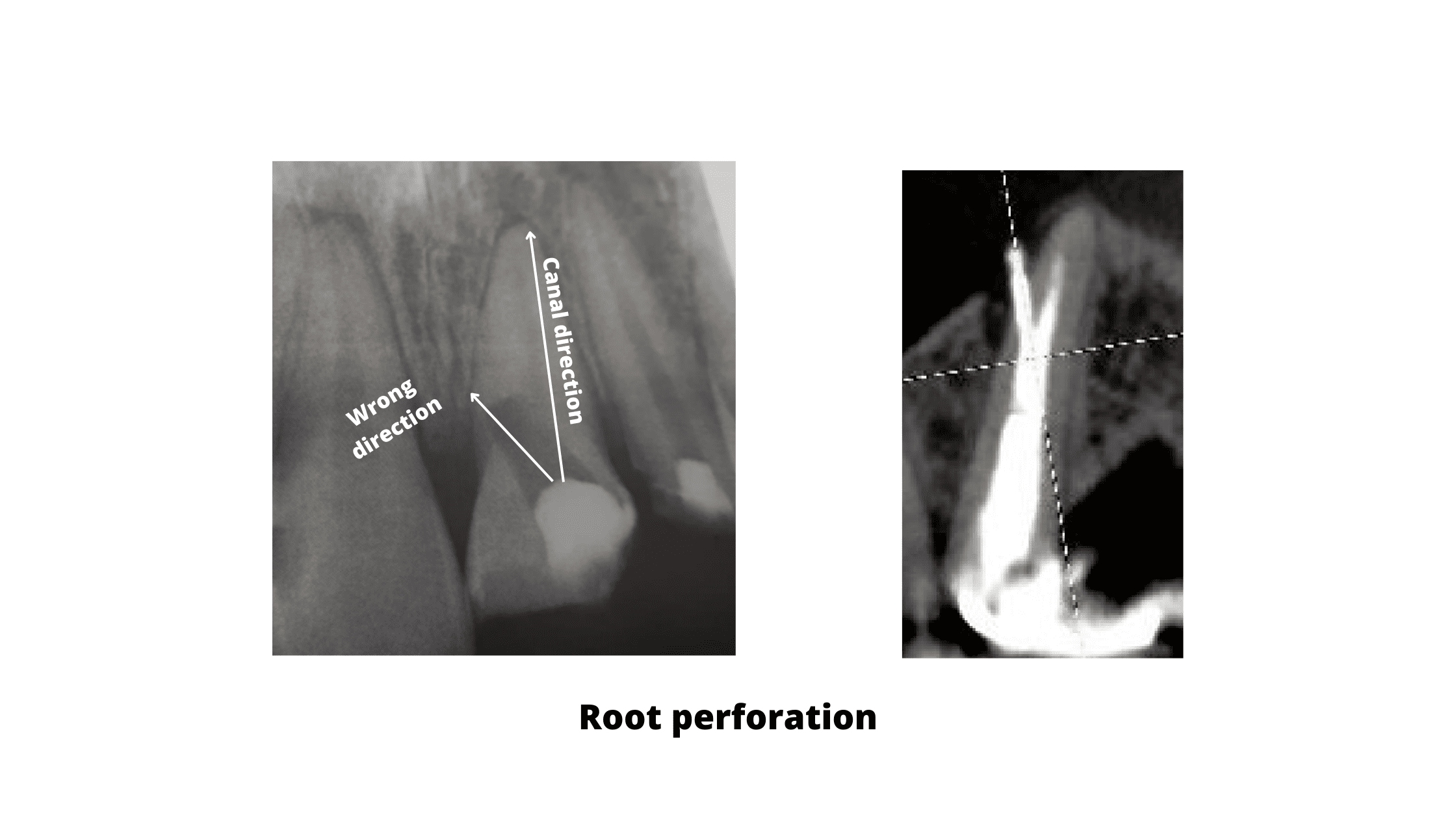 Root perforation (x-ray image)