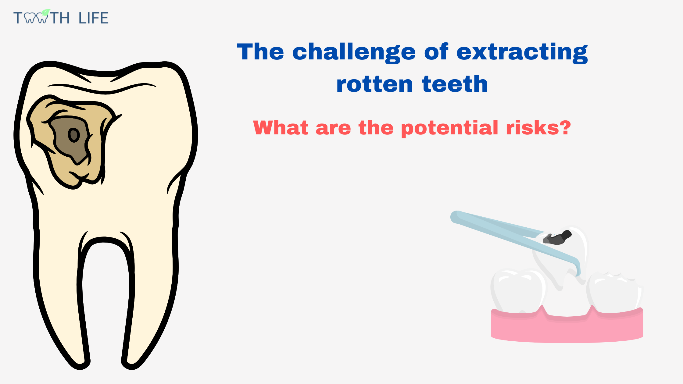Rotten tooth extraction: Risks and Complications
