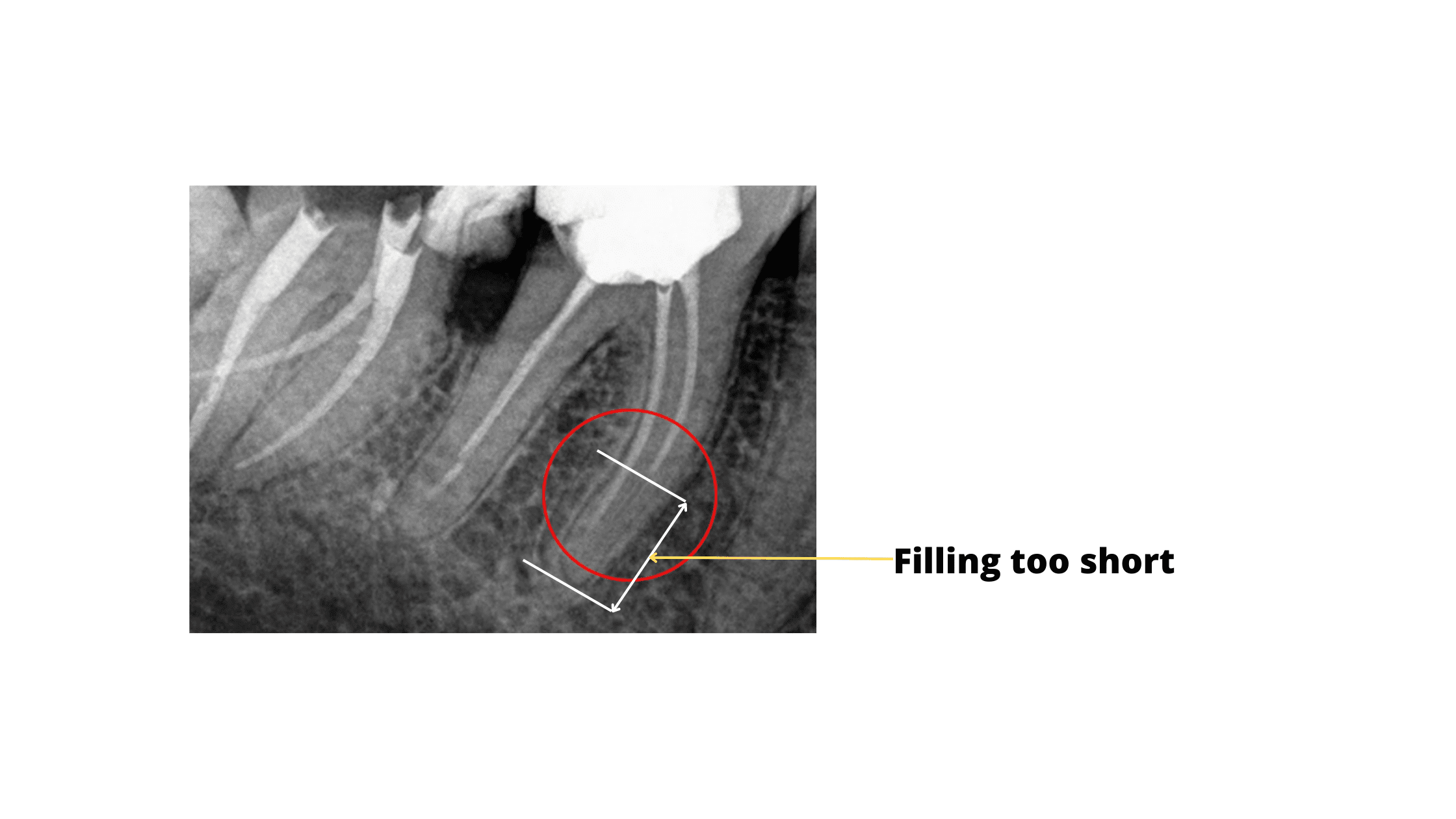 Root canal filling too short (x-ray image)