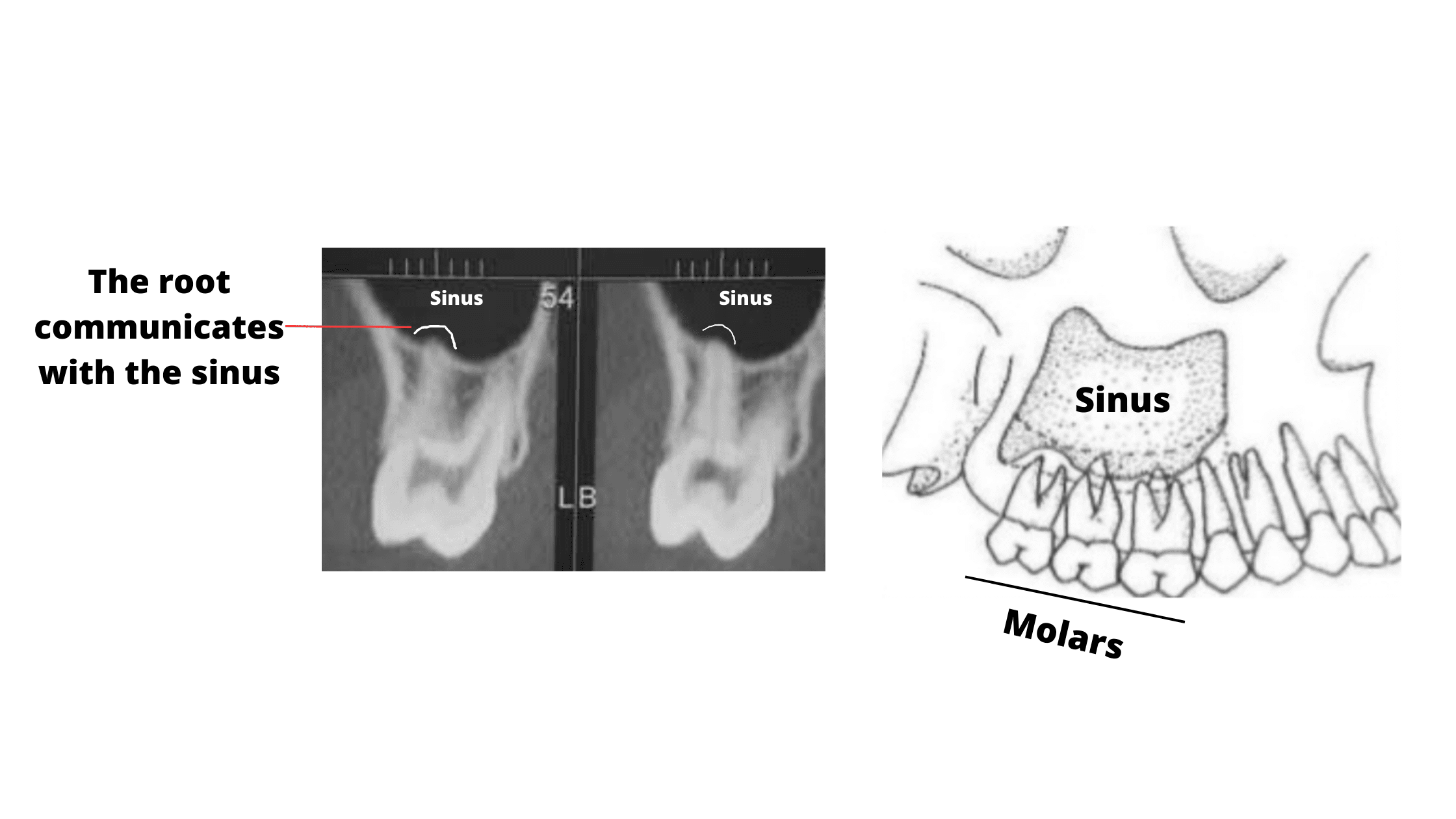 molar teeth communicating with the sinus