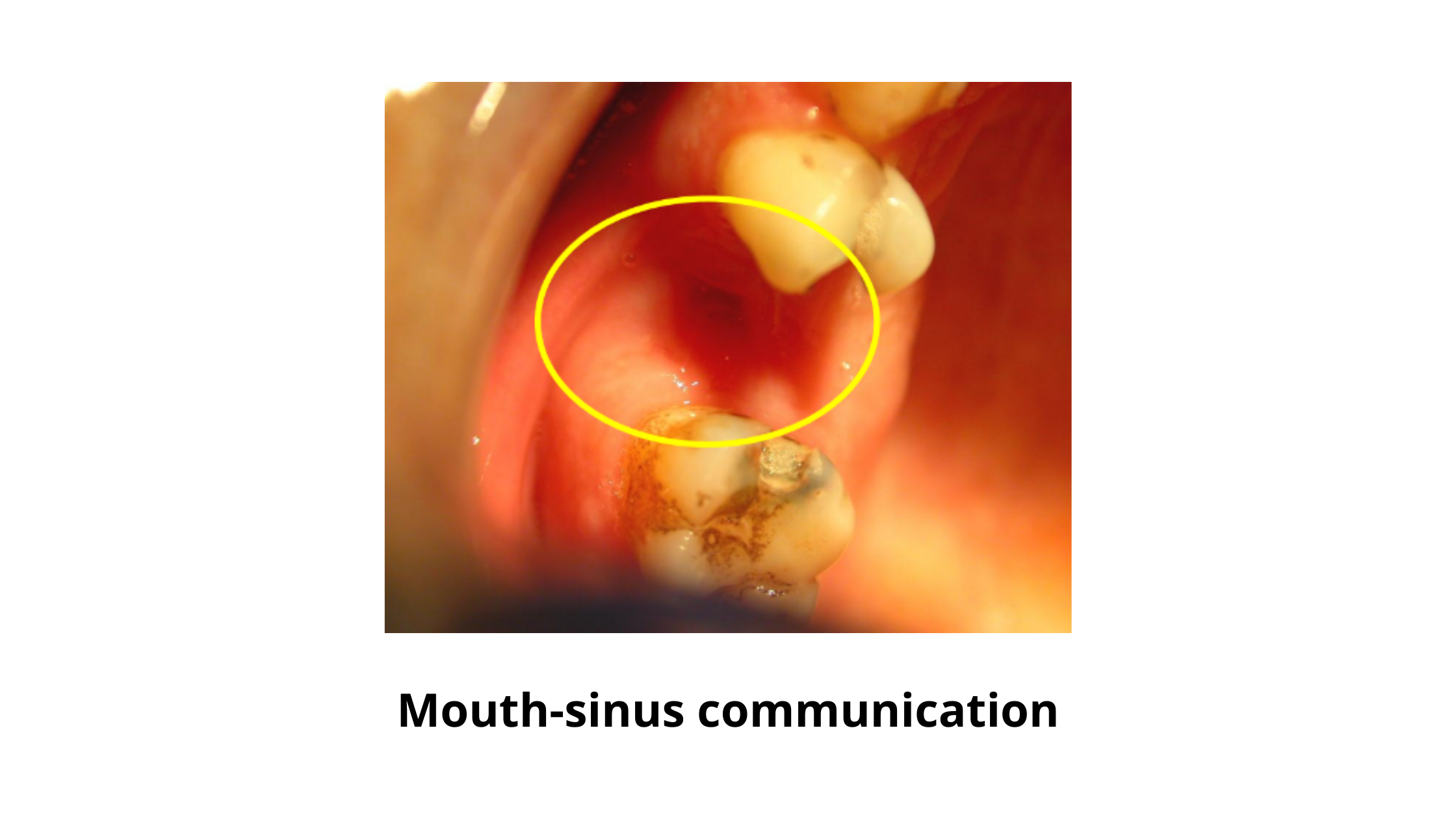 Sinus communication after tooth extraction