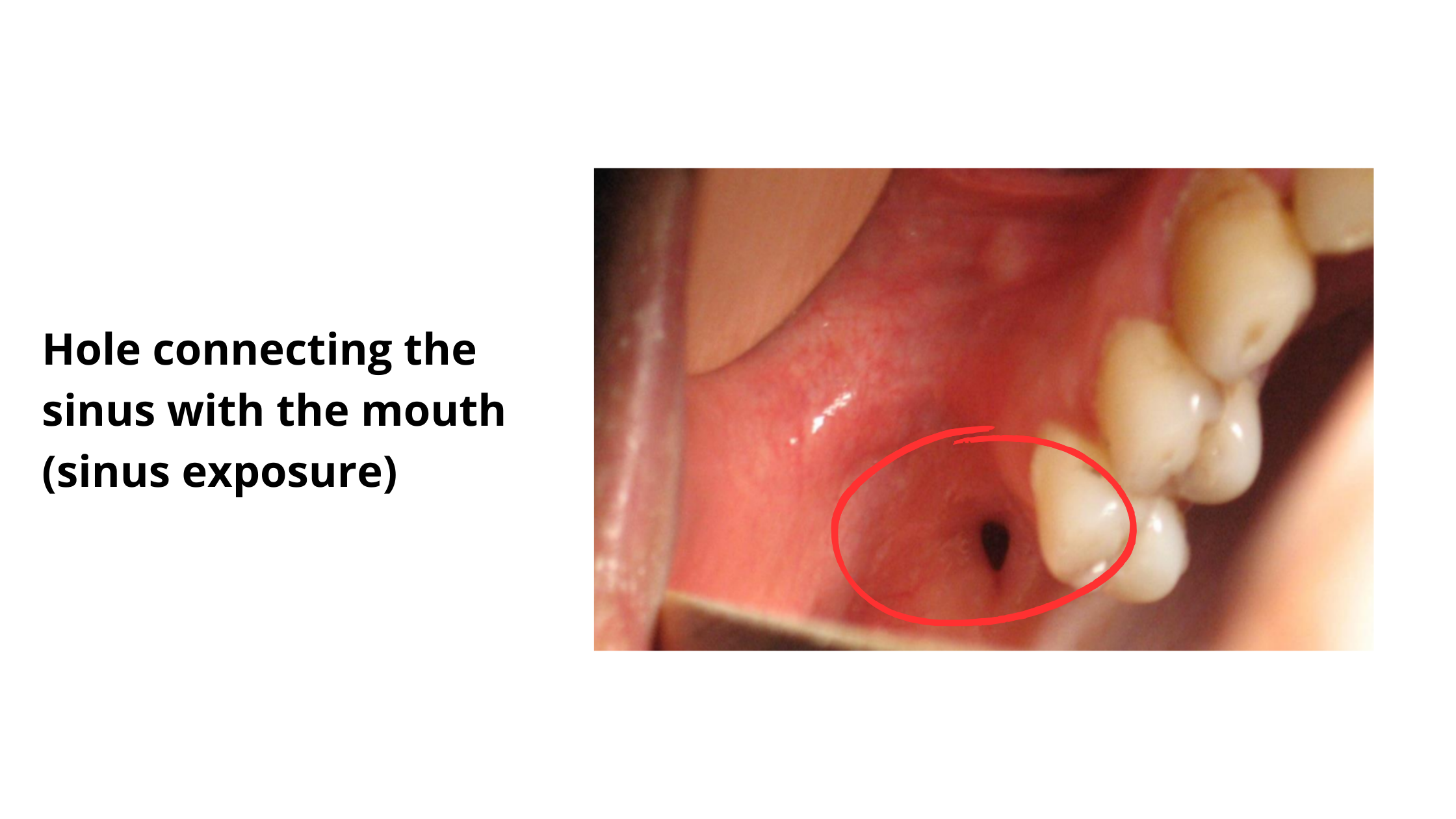 Clinical image showing a hole connecting the mouth to the sinus, resulting in oro-antral communication