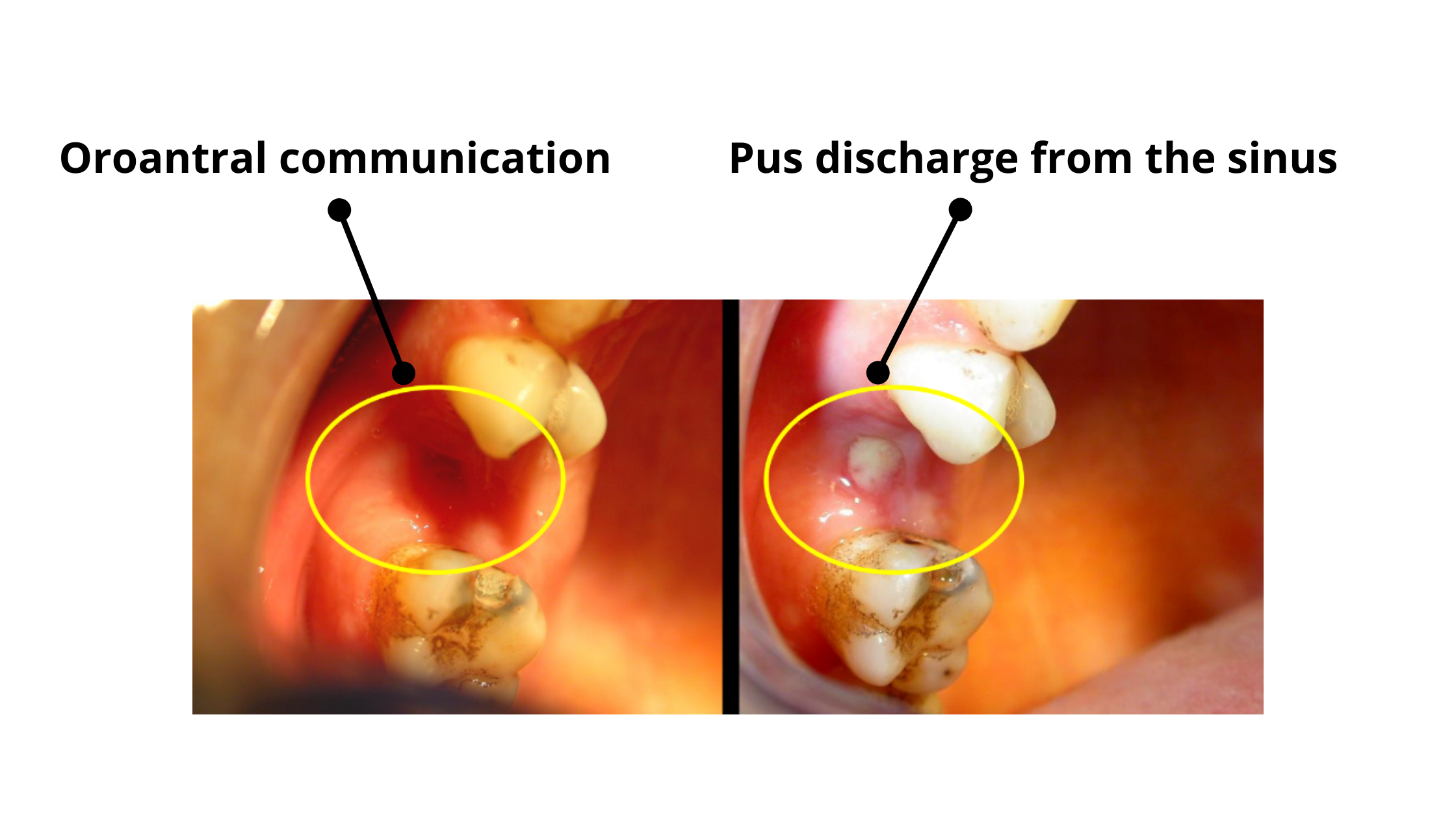 Clinical case of sinus infection after tooth extraction
