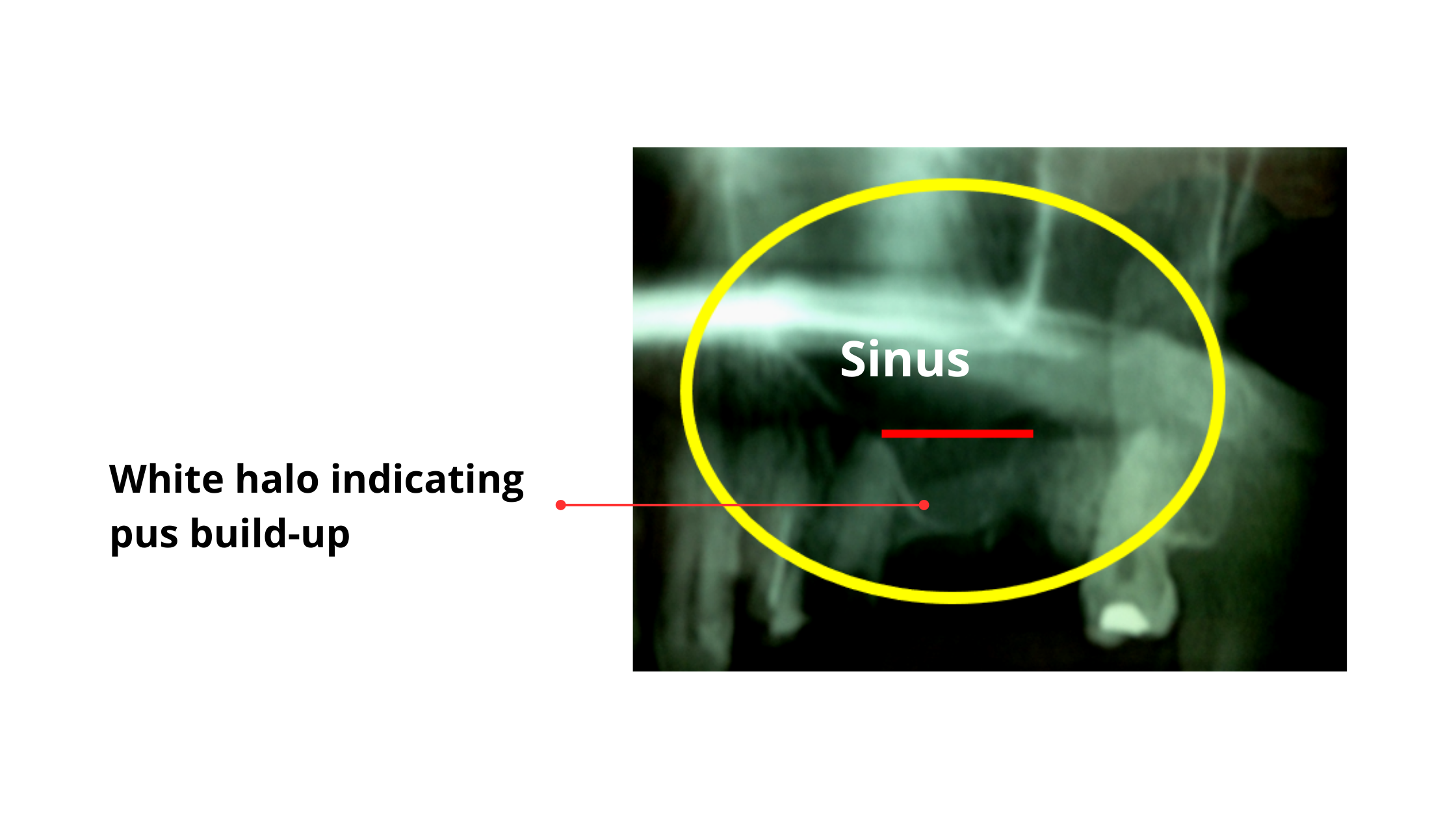 Sinus infection on panoramic x-ray