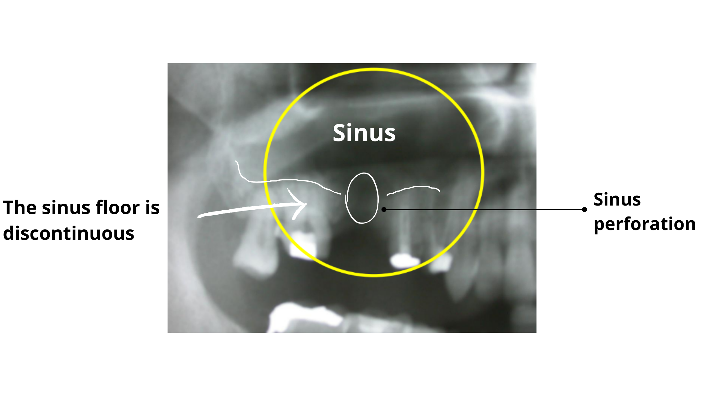 Sinus perforation on panoramic dental x-ray