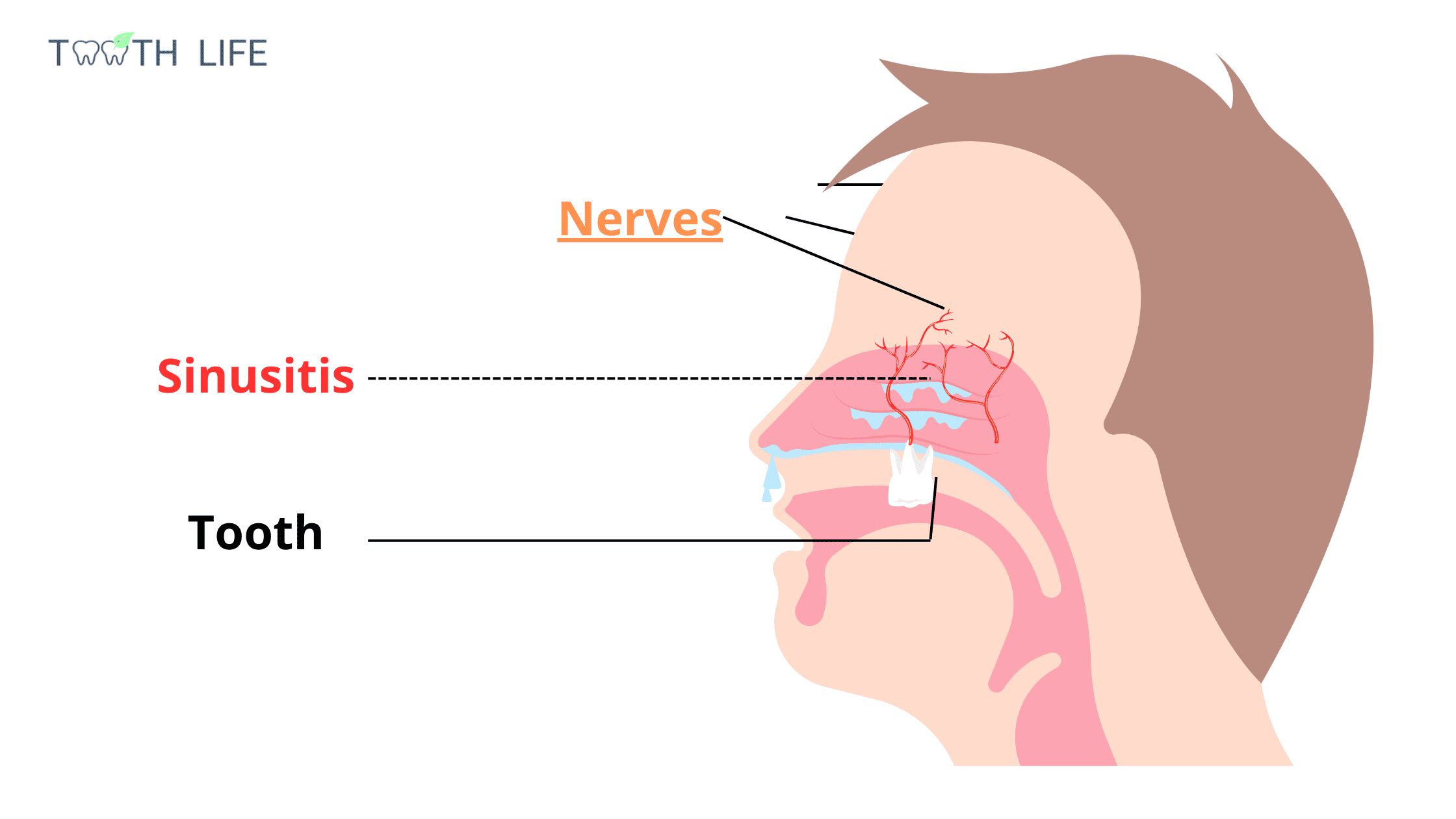 the innervation of the maxillary sinus and the upper back teeth