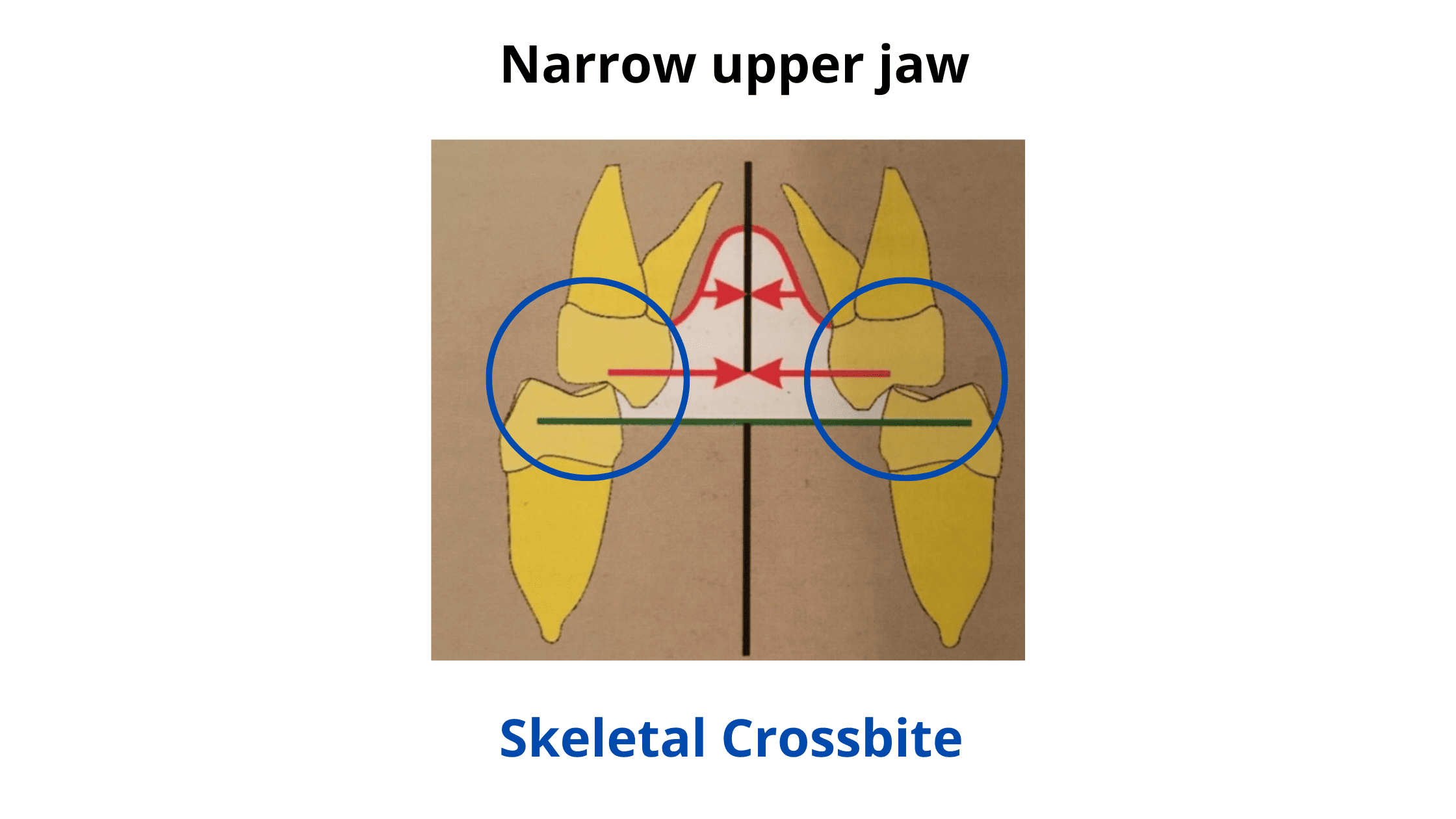 skeletal crossbite