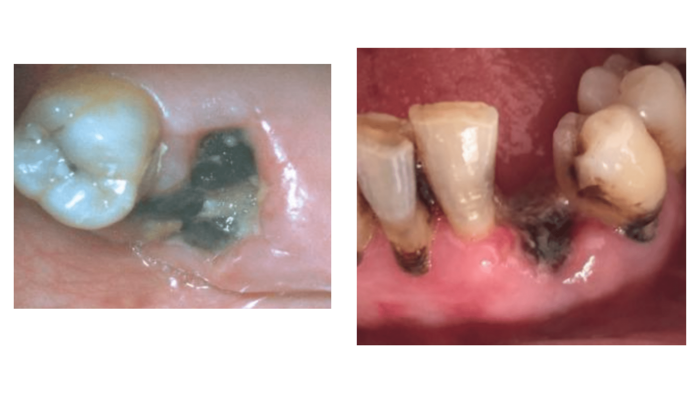 Socket infection after tooth extraction: Clinical images