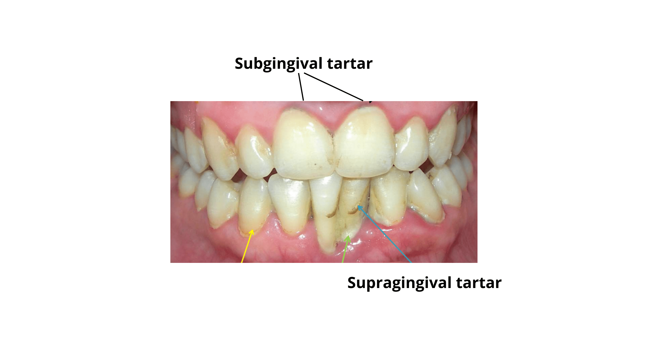 subgingival tartar and supragingival tartar