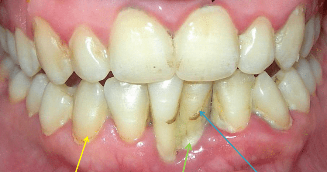 tartar build-up on the teeth