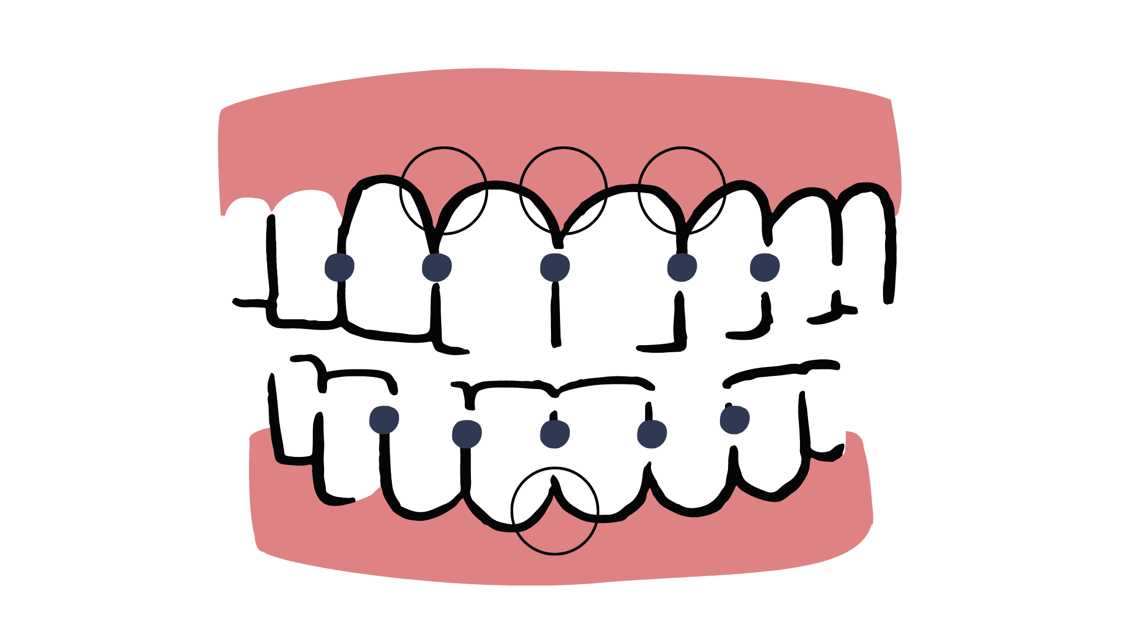 Teeth contact point and surrounding papilla