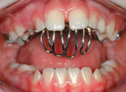 tongue guard to correct tongue posture