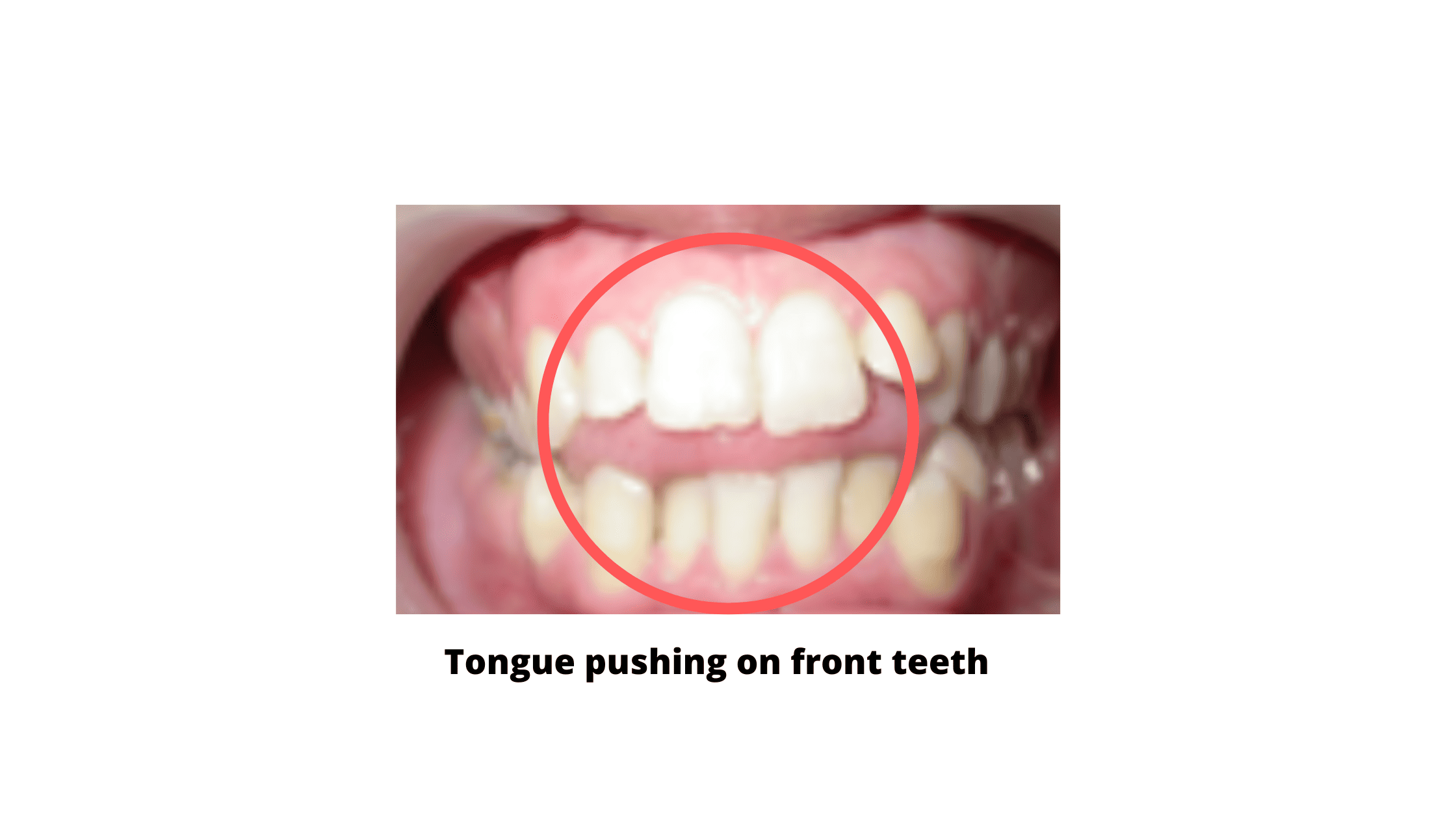 Tongue pushing on front teeth in an open bite