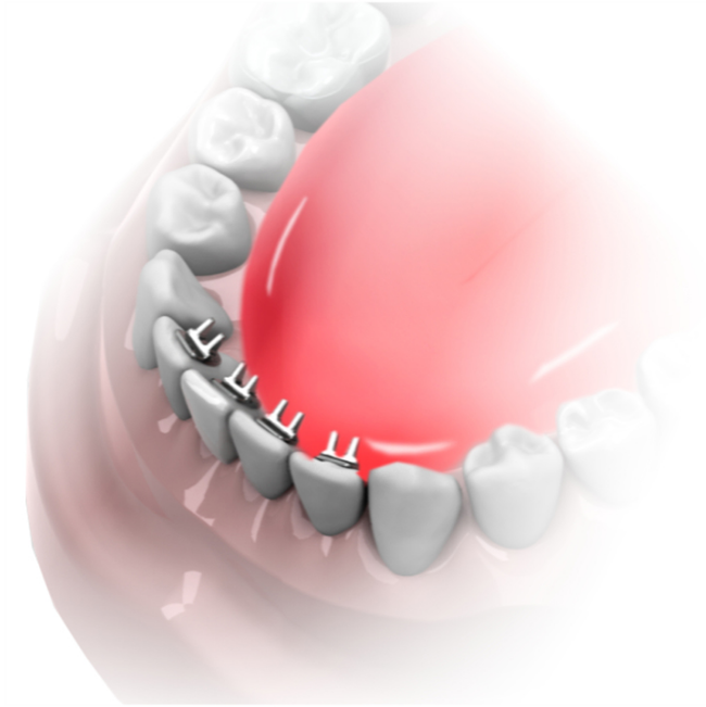 tongue spikes braces