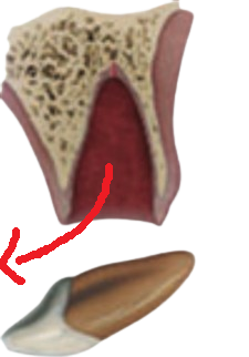 tooth avulsion