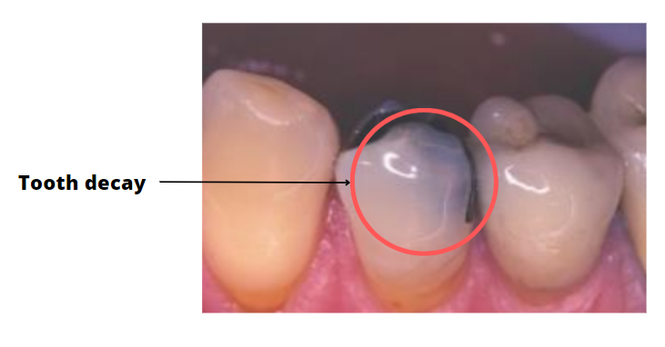 tooth decay after a dental filling
