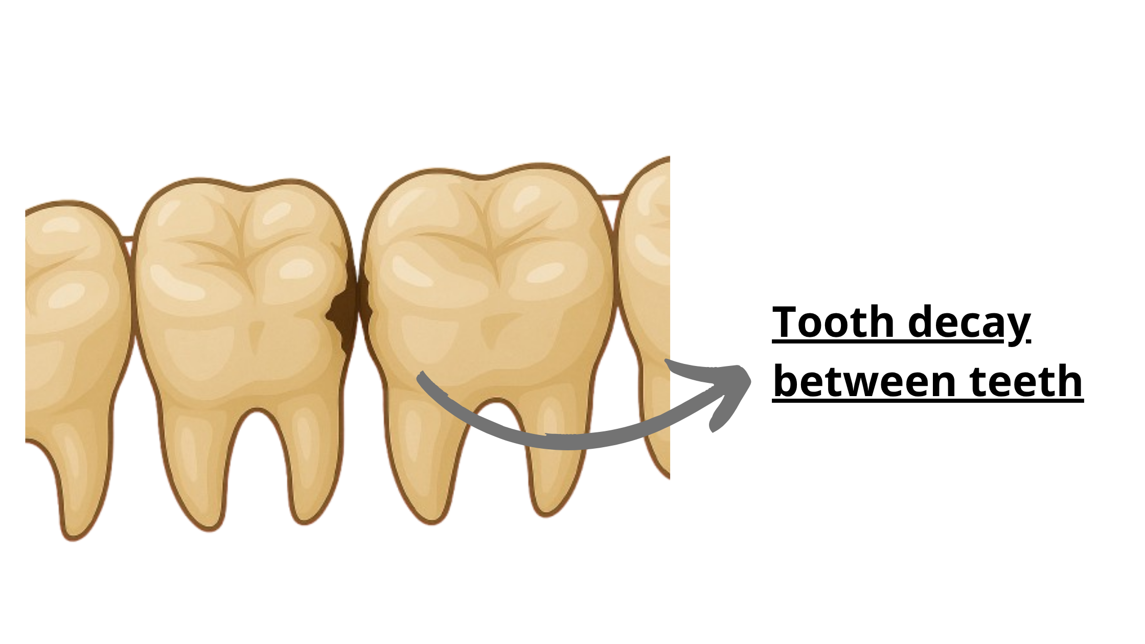 tooth decay between teeth