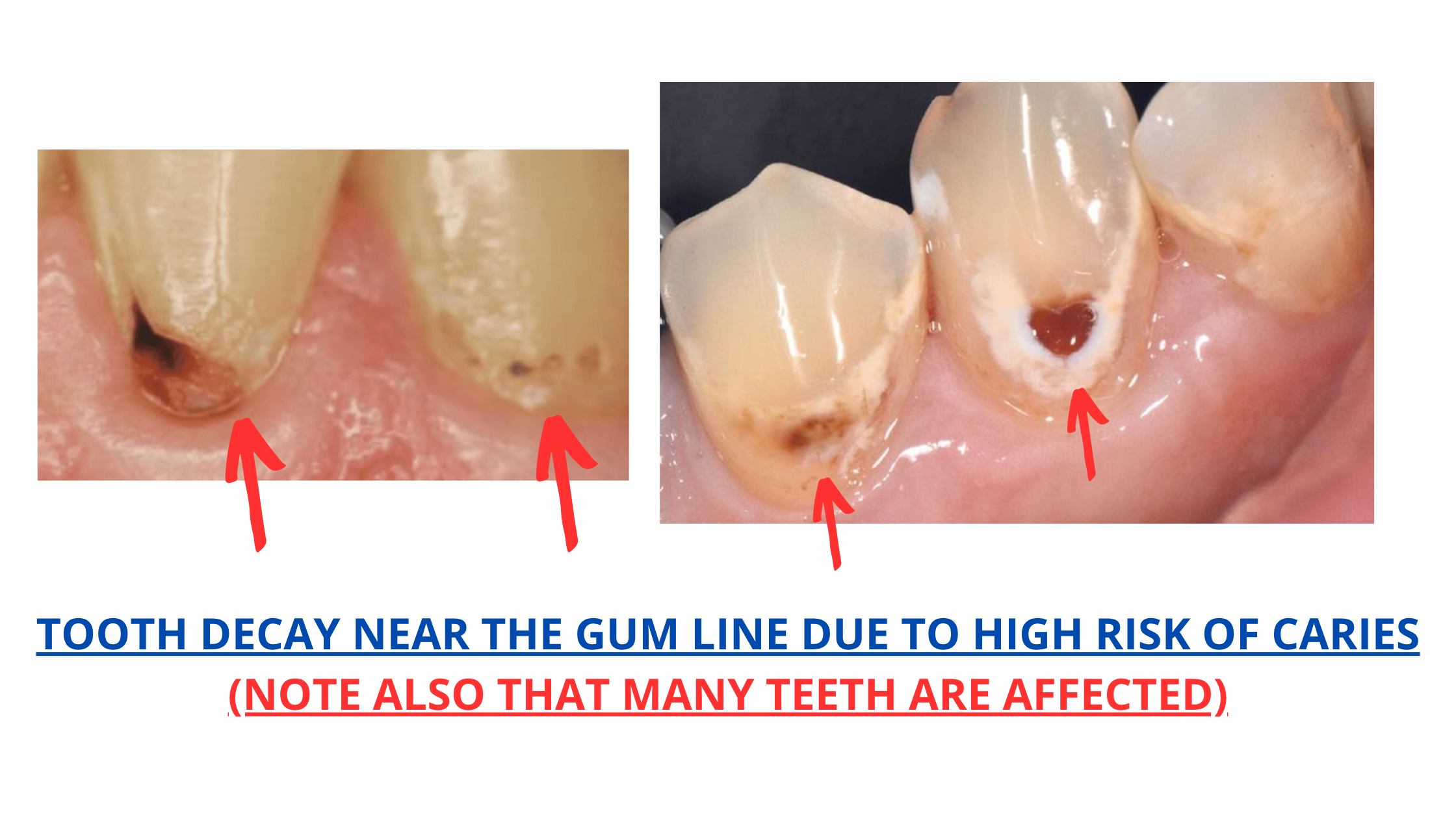 tooth decay at the gum line is a sign of high caries risk