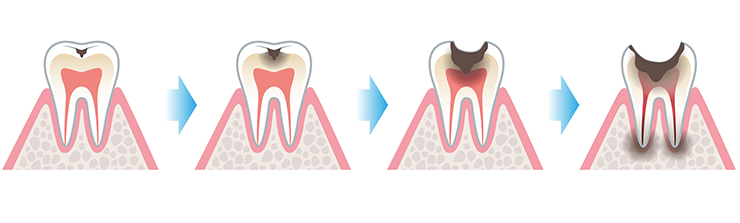 tooth decay