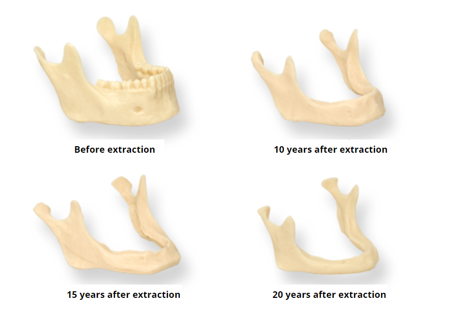 bone loss after tooth extraction: the effects on the jawbone