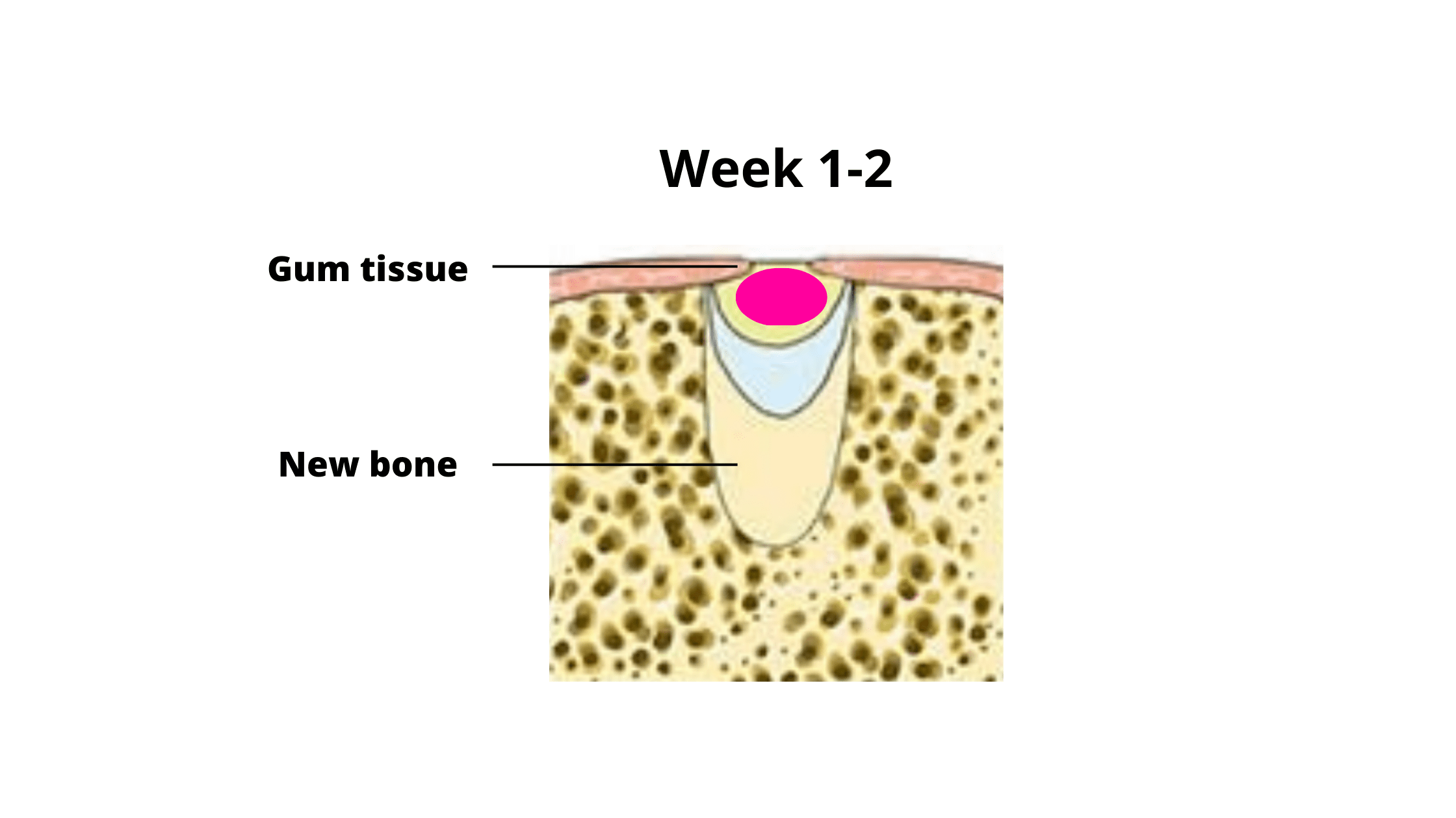 tooth extraction healing: immature bone formation