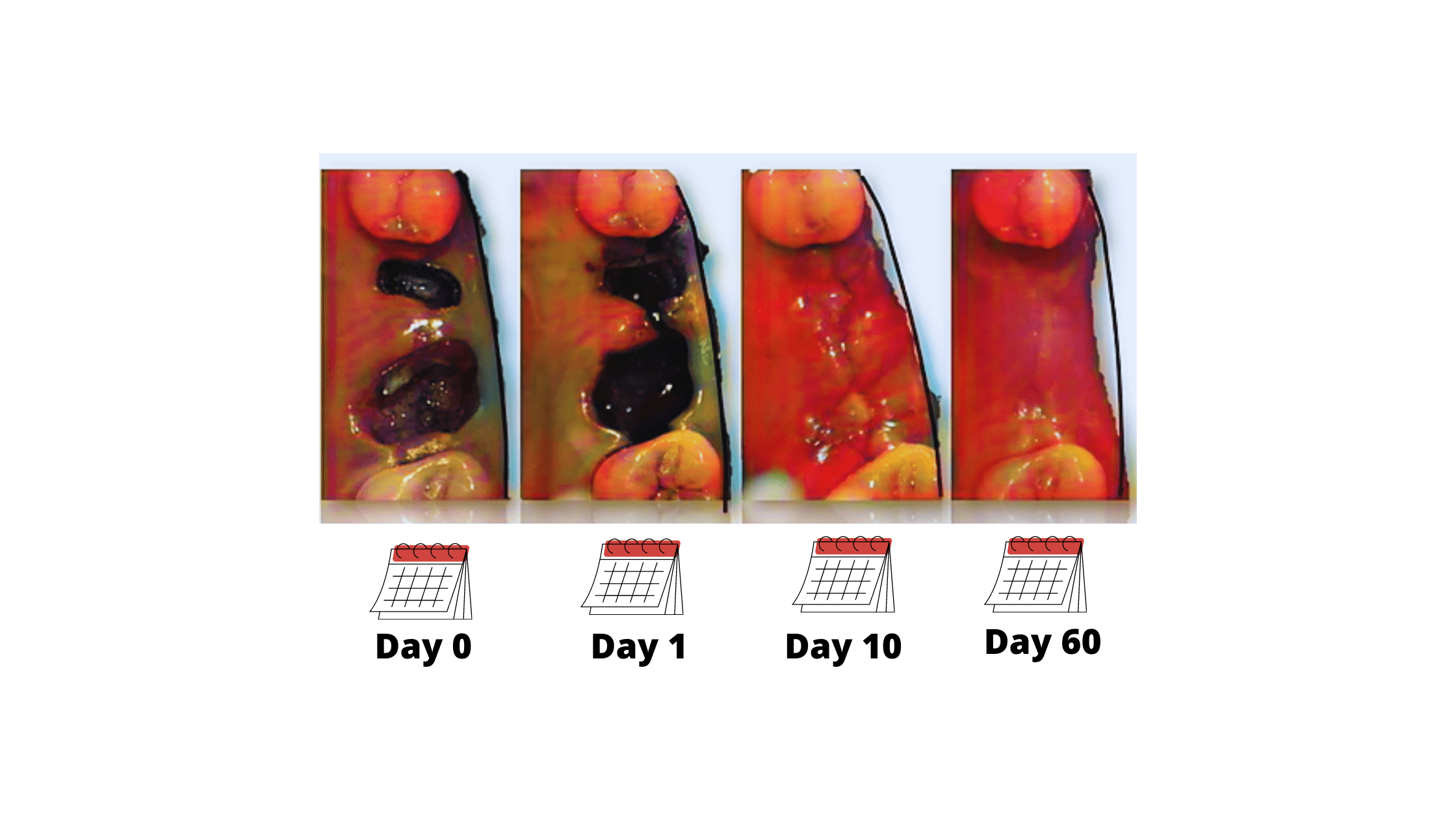 Healing stages after tooth extraction: from day 0 to day 60