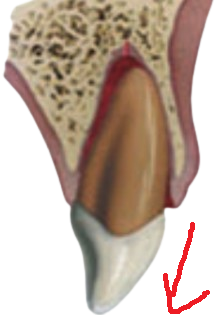Tooth extrusion