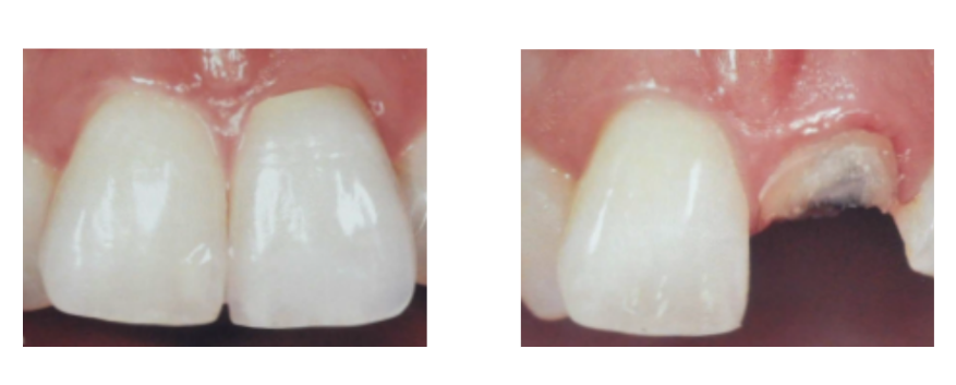 tooth fracture after a dental crown