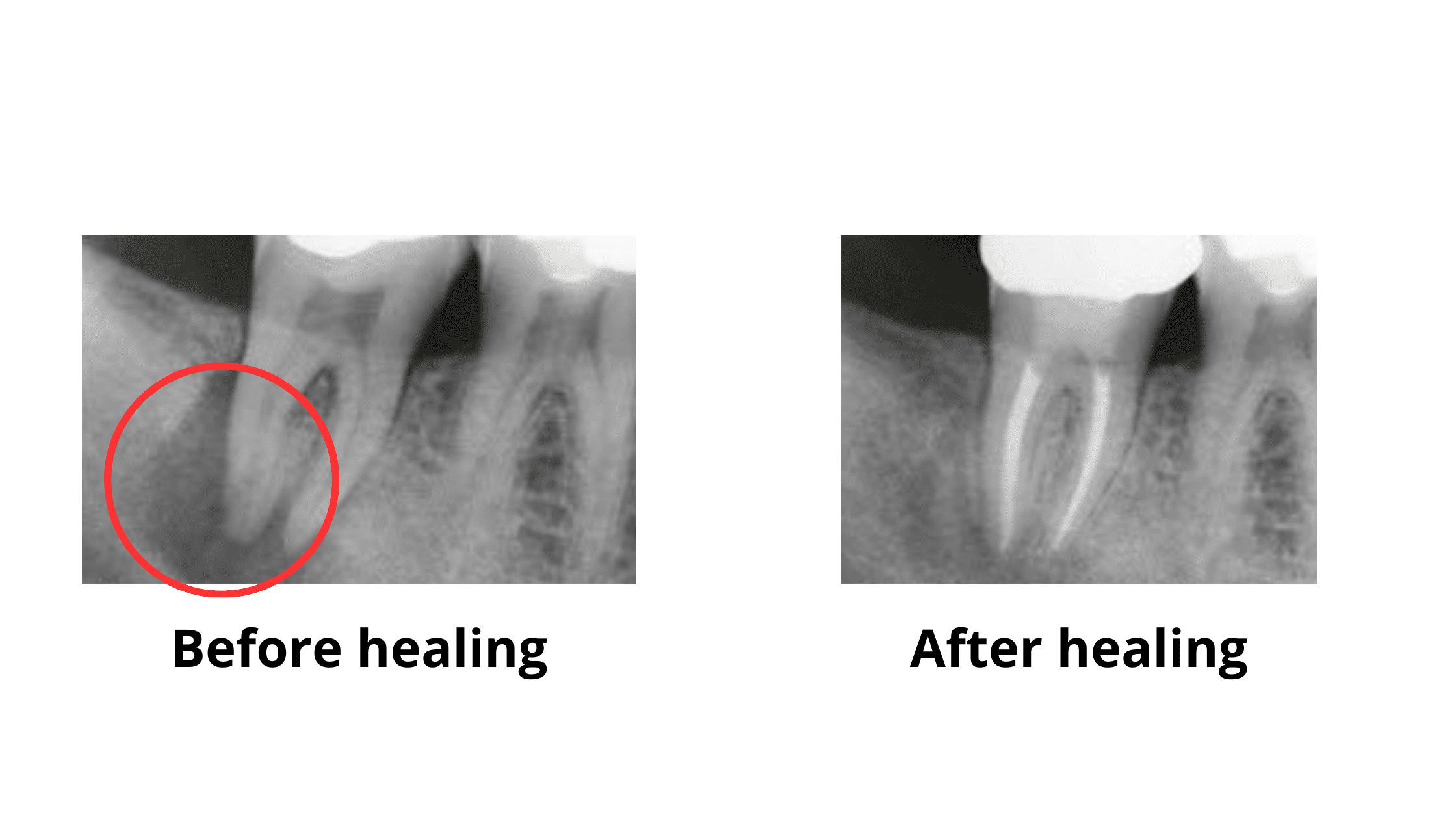 X-ray photos before and after root canal treatment: signs of healing