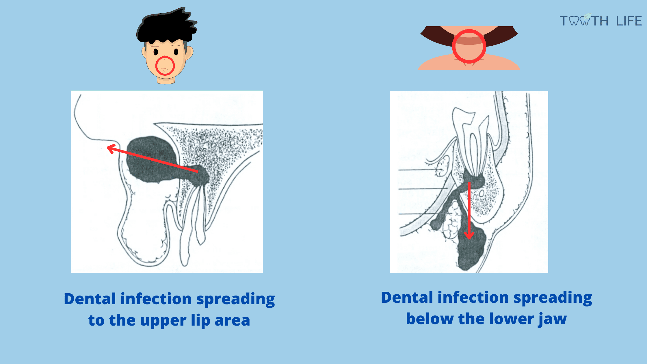tooth infection spreading to face: upper lip and neck area