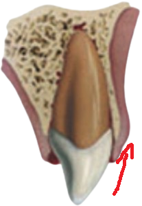 tooth intrusion