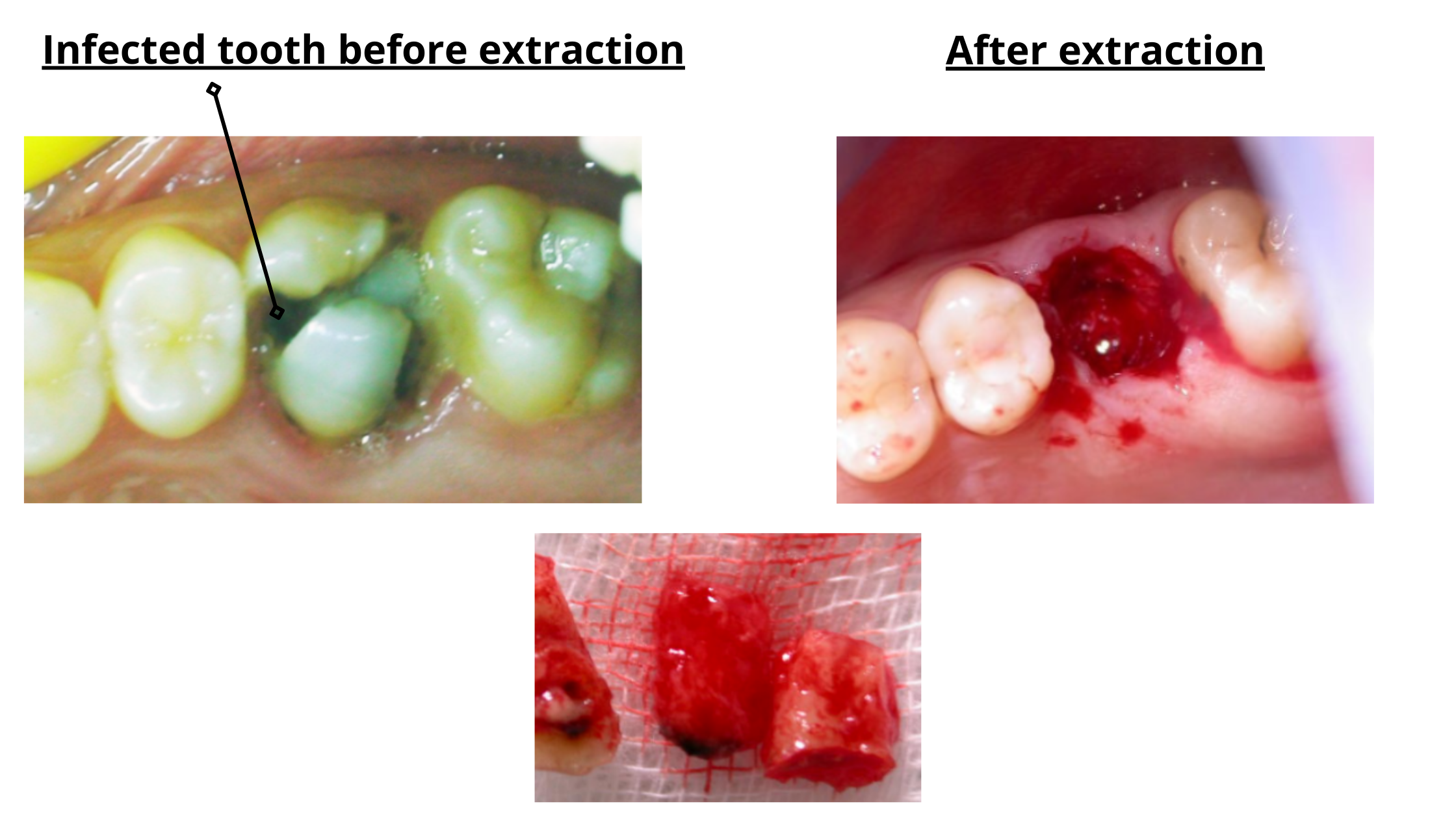 clinical images of infected tooth extraction using tooth sectioning technique: Before and After