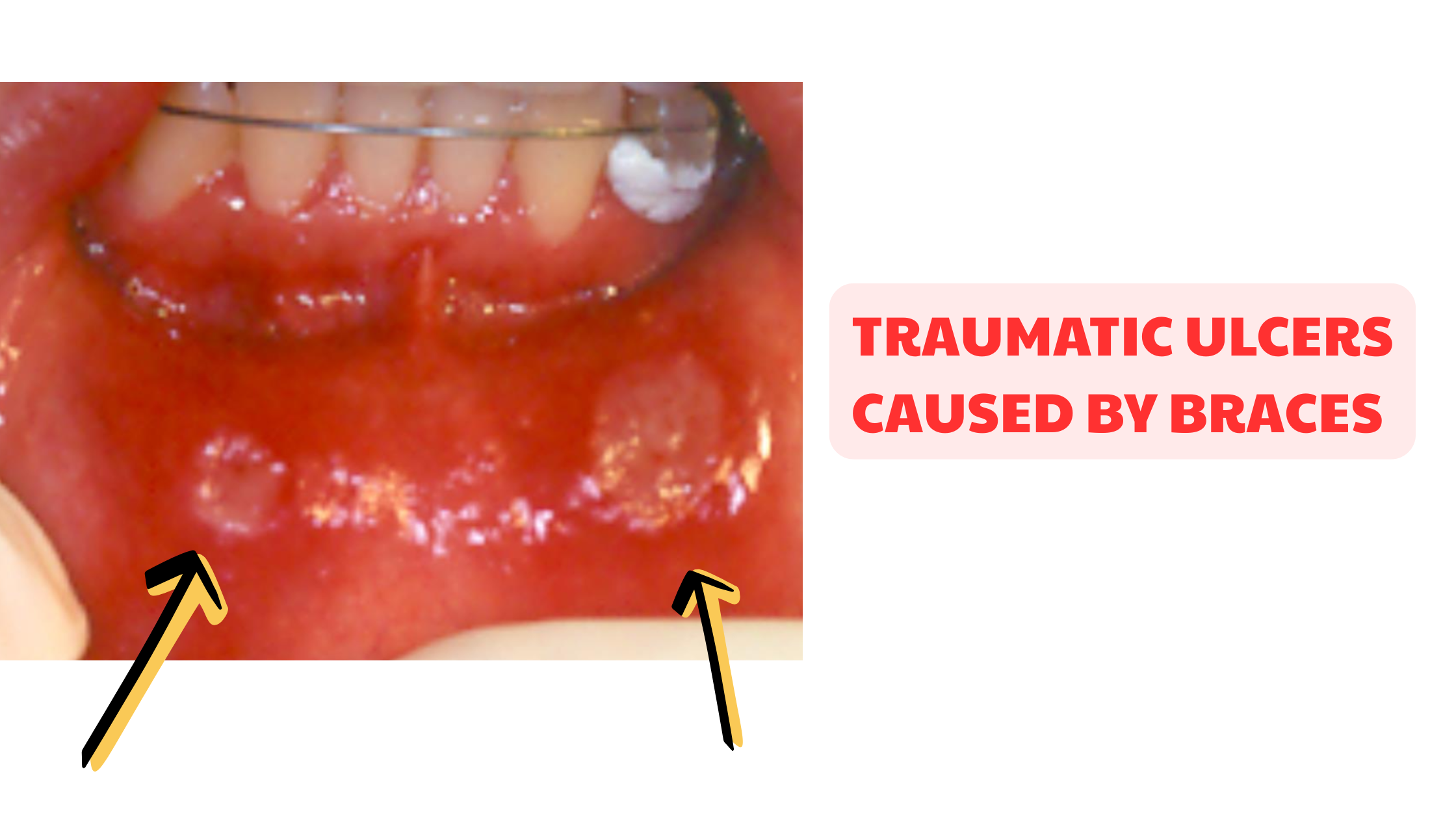 Traumatic ulcers on the lower lip caused by braces