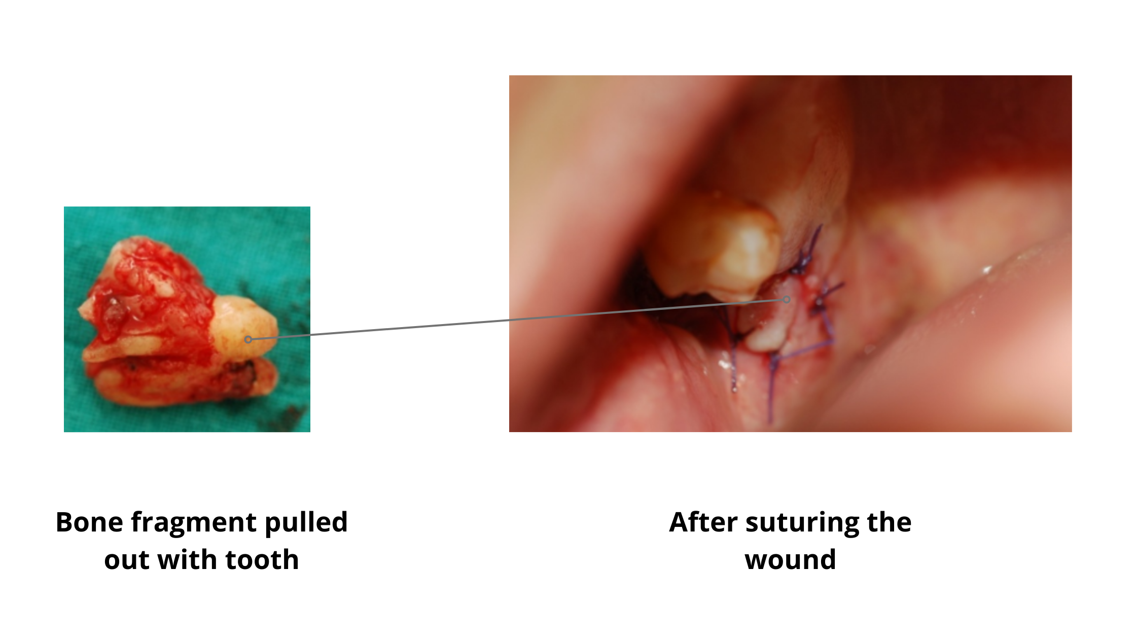 Treatment of intraoperative bone damage following wisdom tooth extraction