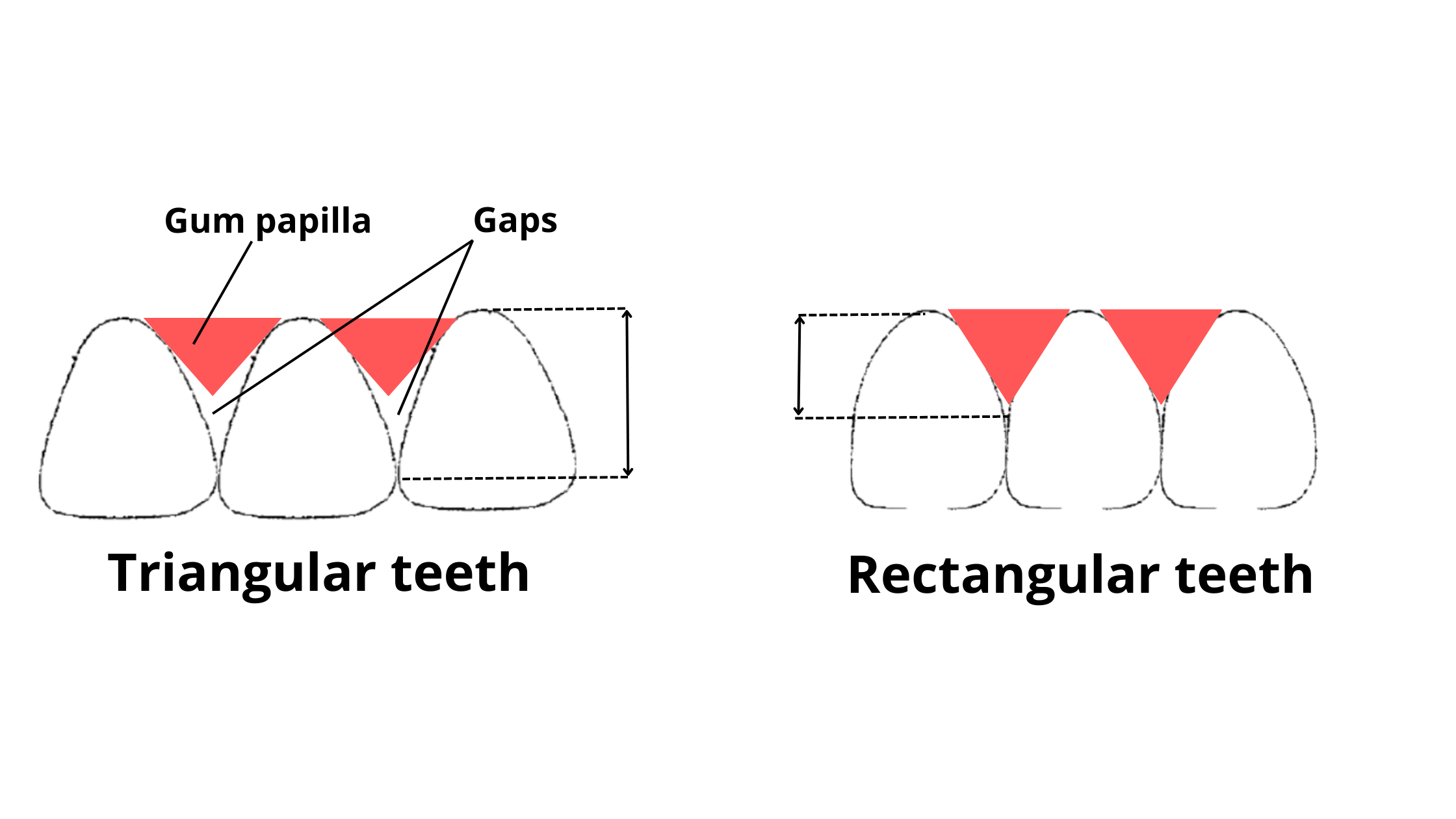 triangular teeth cause more gap too appear than rectangular teeth