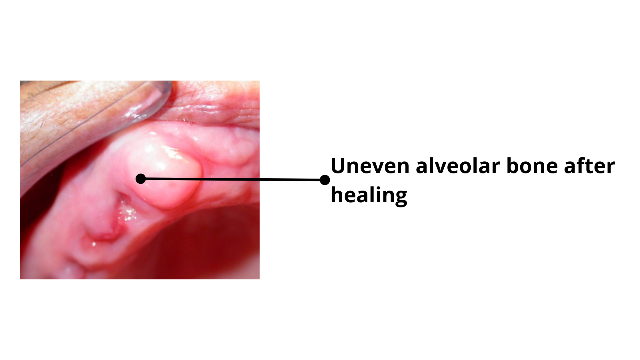 Irregular alveolar bone ridge after tooth extraction healing