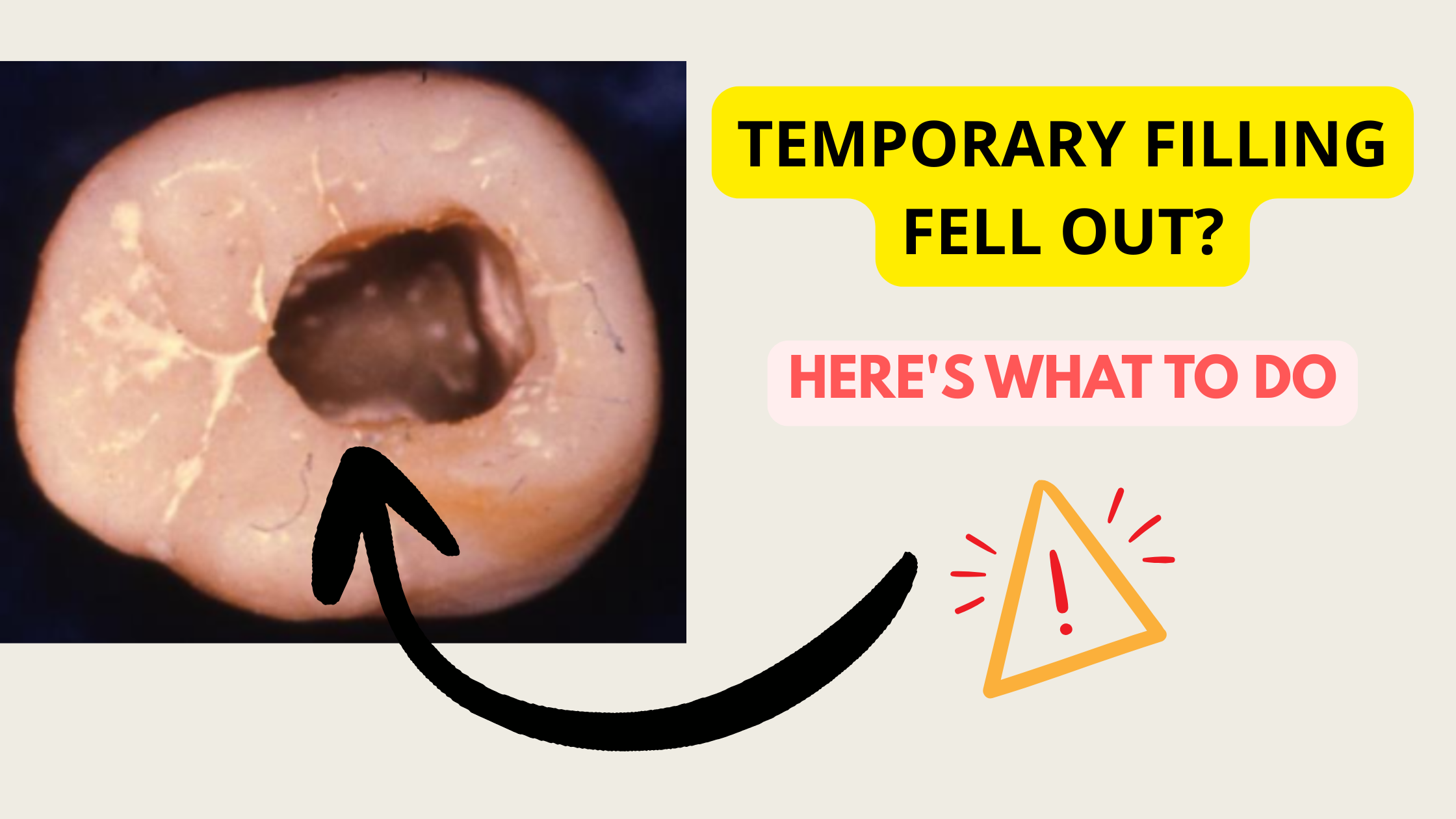 Temporary filling fell out after root canal treatment