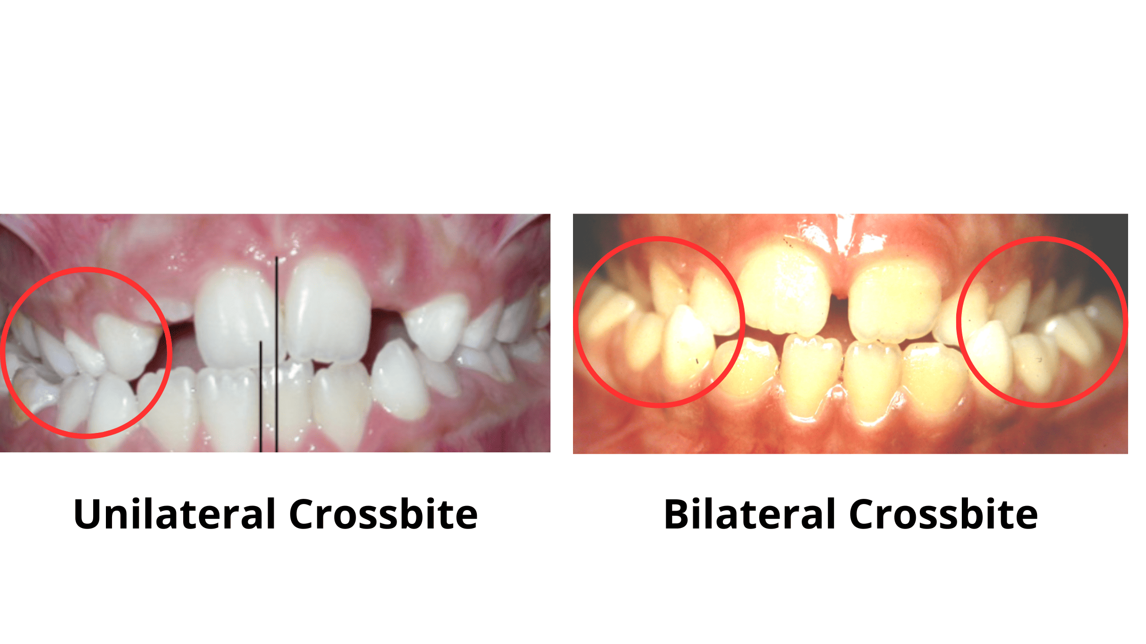 Unilateral vs. Bilateral crossbite