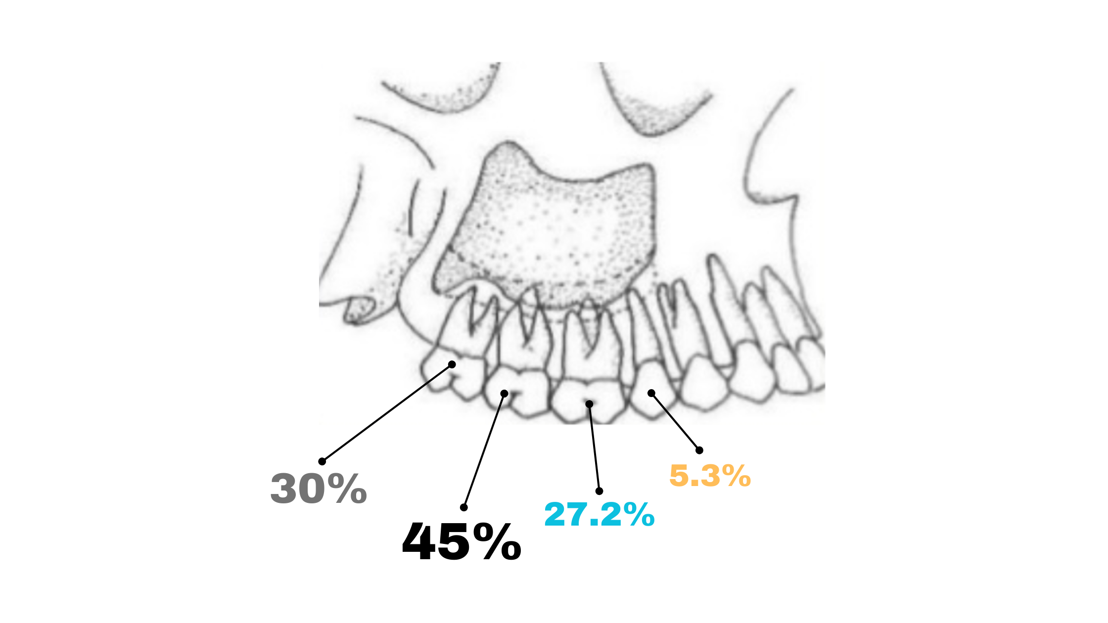 The upper back teeth most involved in sinus complication