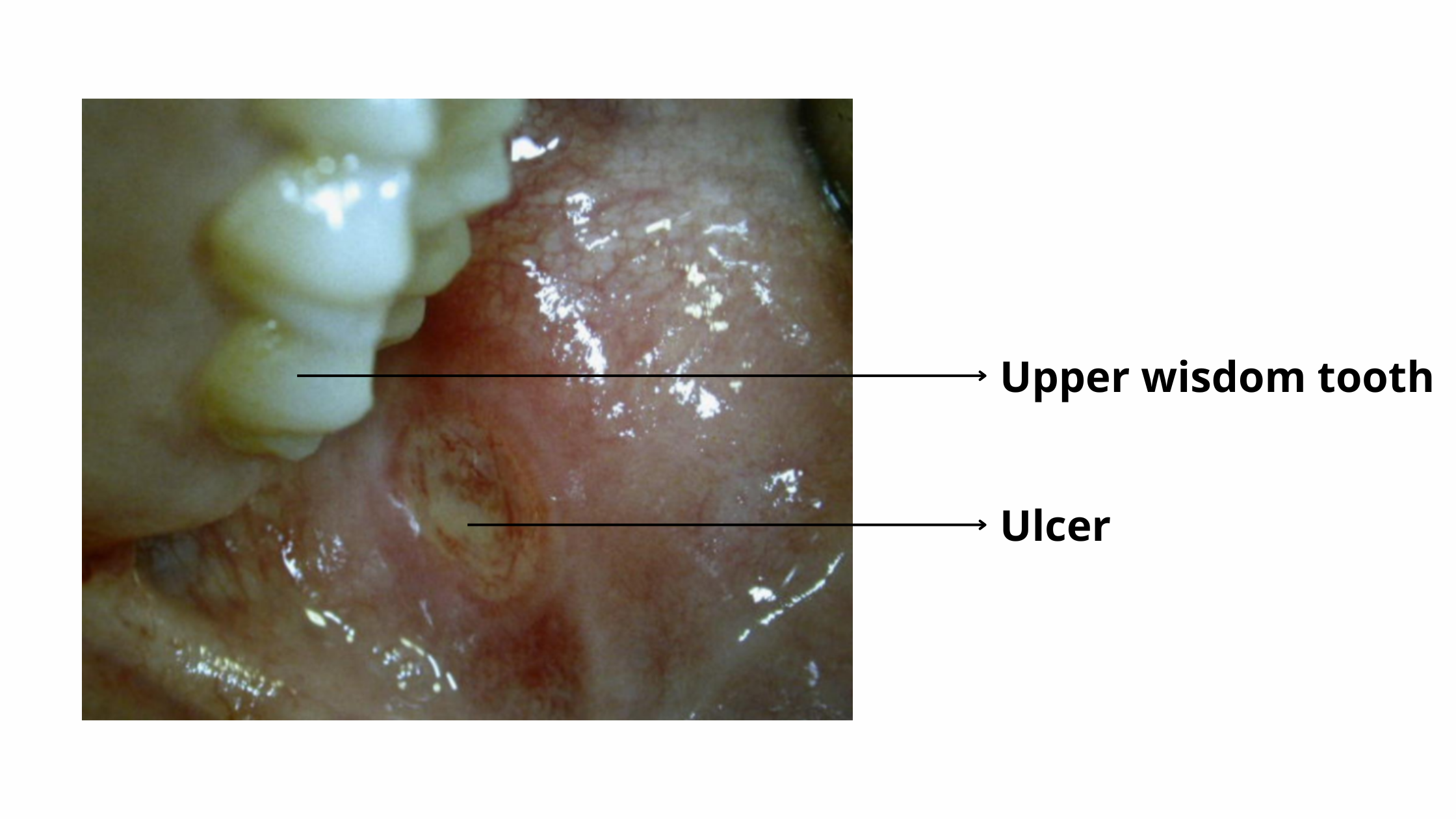 Clinical image of an upper wisdom tooth growing sideways towards cheek and causing an ulcer.