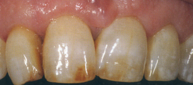 Indication for veneers due to tooth discoloration