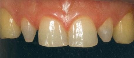 Indication for veneers due to misshapen front teeth