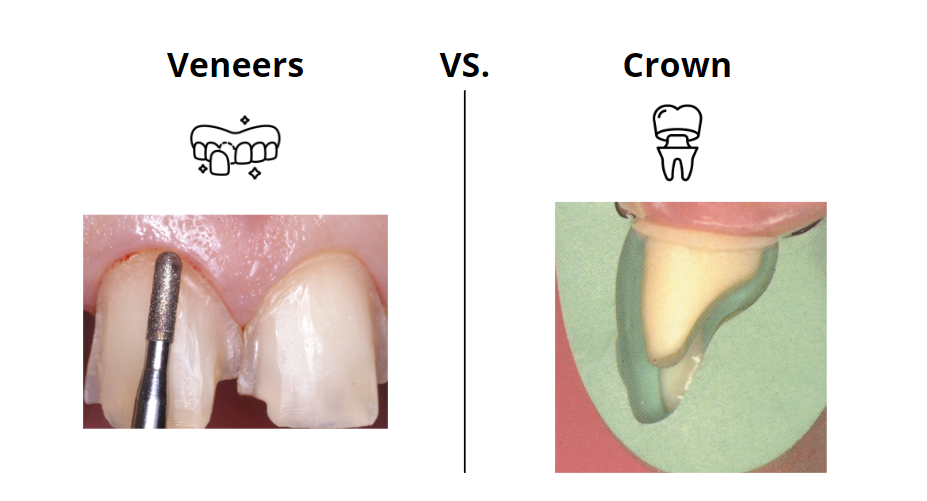Comparison of front tooth preparation for crown and veneer