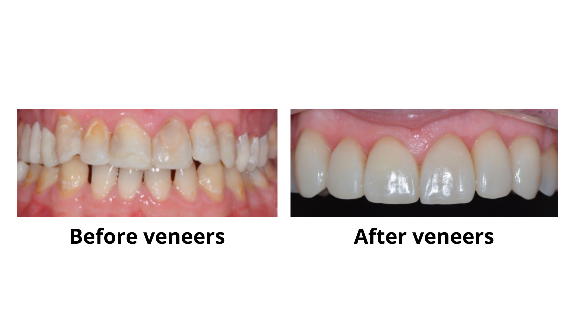 Veneers for worn front teeth: before and after