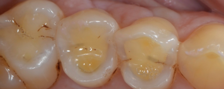 tooth erosion