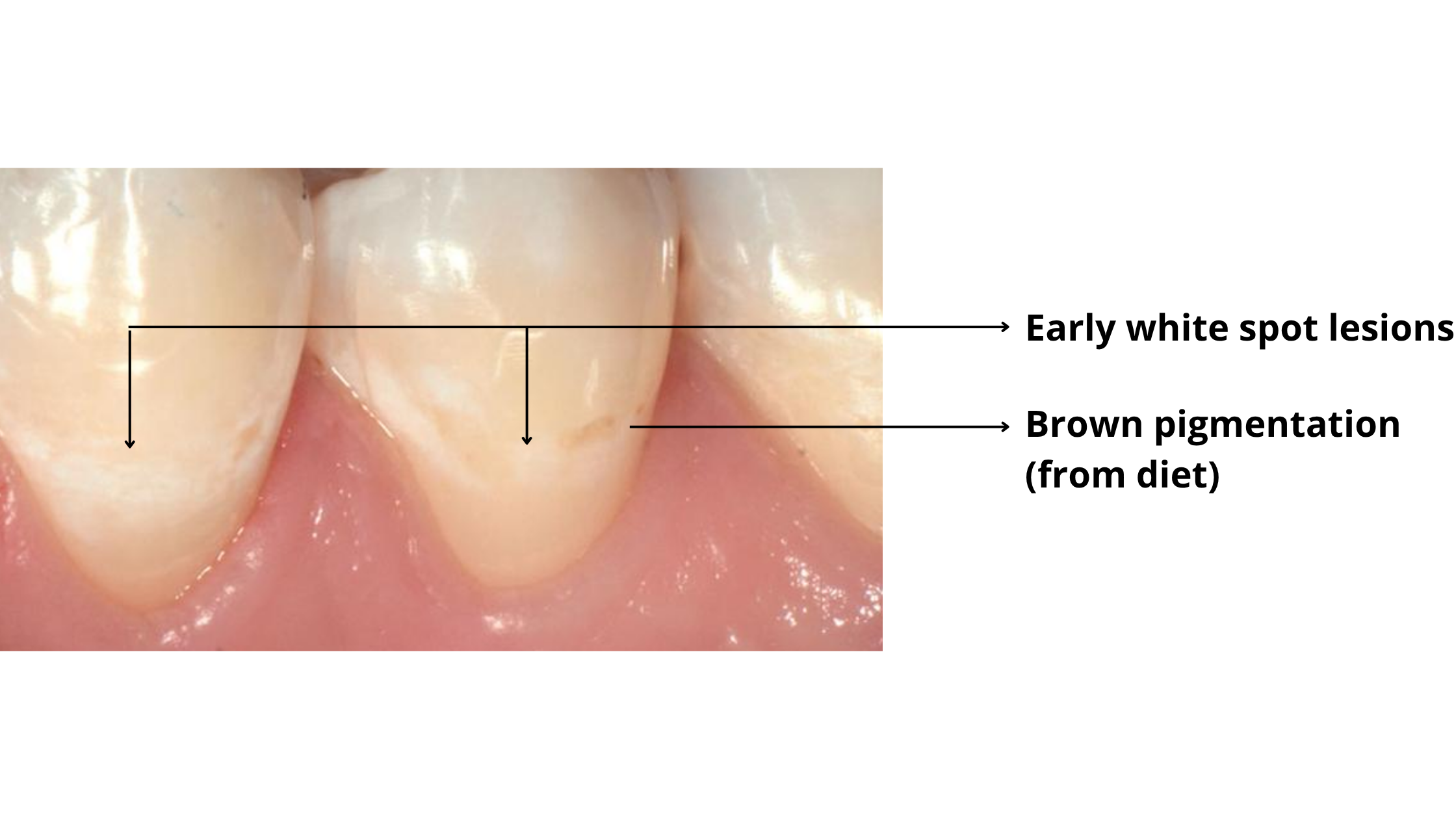 White spots on teeth turning into brown spots 