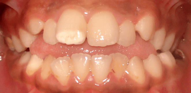 White line on an incisor due to molar and incisor hypomineralization (MIH)