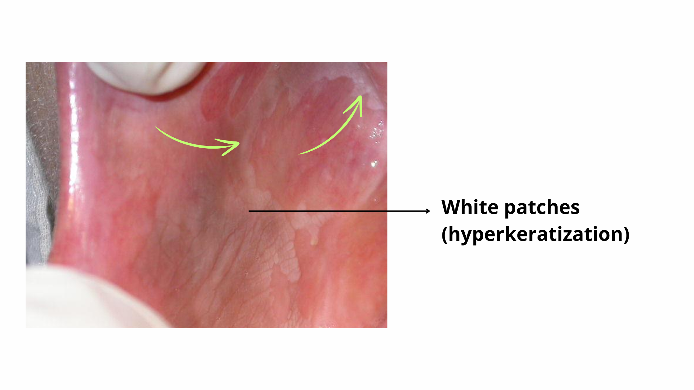 White patches of hyperkeratinization due to chronic irritation on the inside of the cheek